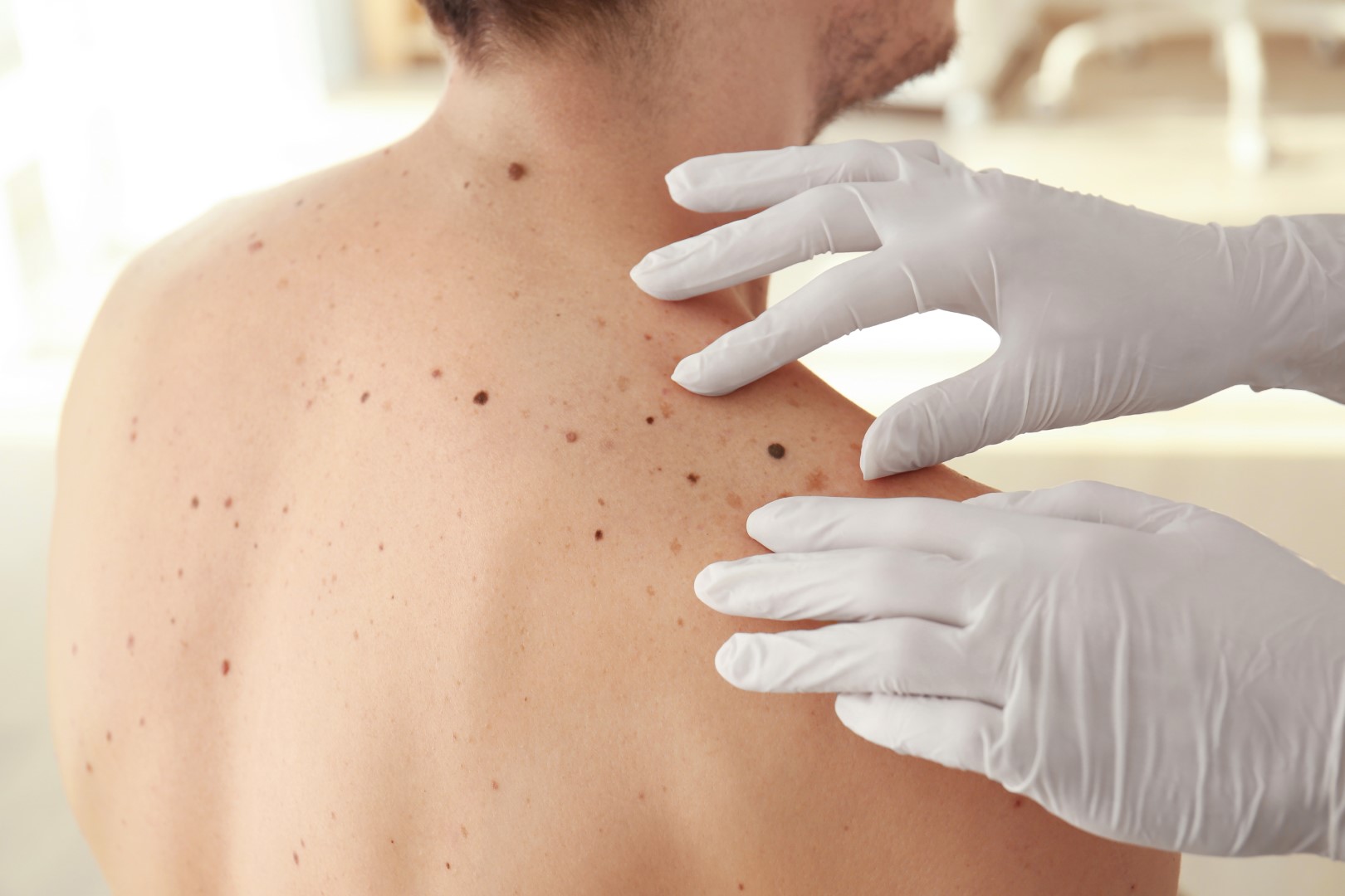 Melanoma Diagnosis and Treatment in Israel